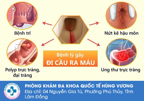 Những nguyên nhân dẫn đến tình trạng đi cầu ra máu.