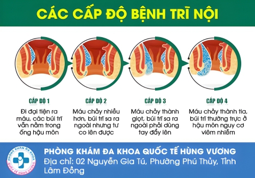 Các cấp độ của bệnh trĩ.