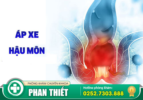Những điều cần biết về apxe hậu môn