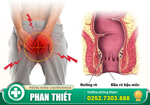 Rò hậu môn là bệnh gì? Có nguy hiểm không?