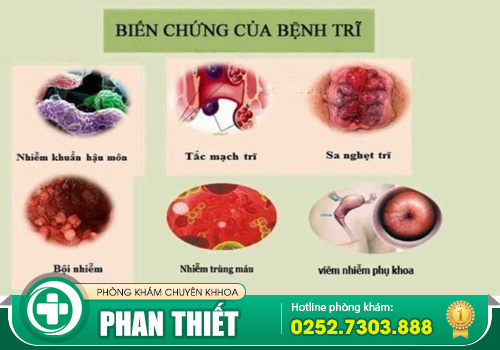 Tổng hợp biểu hiện bệnh trĩ nội, trĩ ngoại và cả trĩ hỗn hợp dễ biết