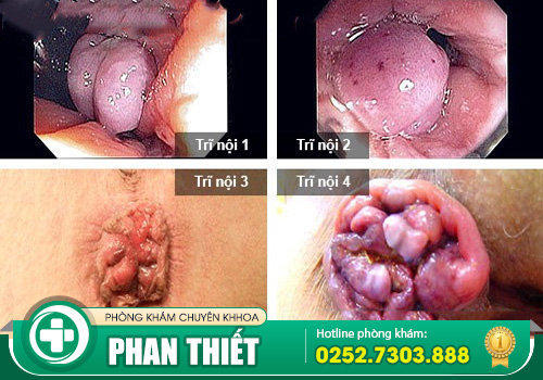 Tổng hợp biểu hiện bệnh trĩ nội, trĩ ngoại và cả trĩ hỗn hợp dễ biết