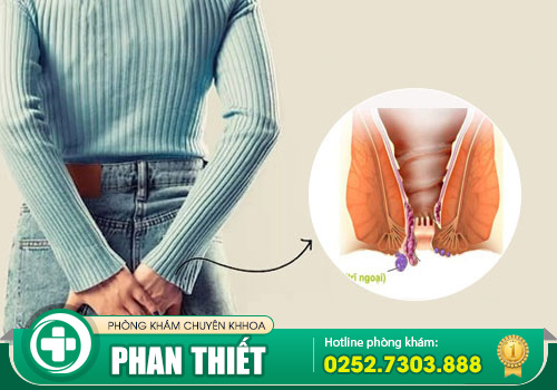 Bệnh trĩ ngoại: nguyên nhân, triệu chứng và cách điều trị hiệu quả