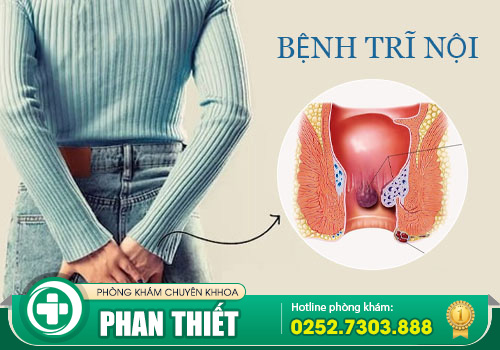 Bệnh trĩ nội và những điều bạn cần biết