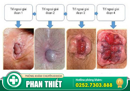 Tổng hợp biểu hiện bệnh trĩ nội, trĩ ngoại và cả trĩ hỗn hợp dễ biết