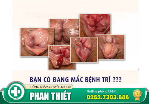 Tổng hợp biểu hiện bệnh trĩ nội, trĩ ngoại và cả trĩ hỗn hợp dễ biết