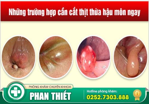 Có nên cắt da thừa hậu môn không?