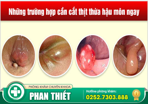 Chi phí cắt da thừa hậu môn bao nhiêu? Bao lâu lành?