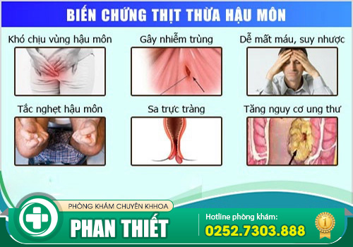 Có nên cắt da thừa hậu môn không?