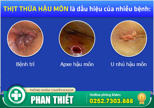 Chi phí cắt da thừa hậu môn không đau - Giá bình dân