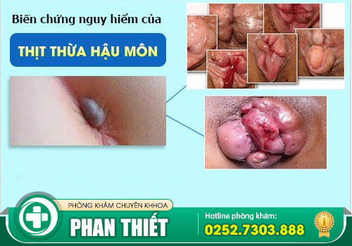 Da dư hậu môn là bệnh gì? Có nguy hiểm không?