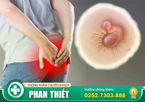 Da dư hậu môn là bệnh gì? Có nguy hiểm không?