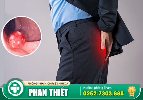 Polyp hậu môn là bệnh gì? Phương pháp chẩn đoán điều trị polyp hậu môn hiệu quả