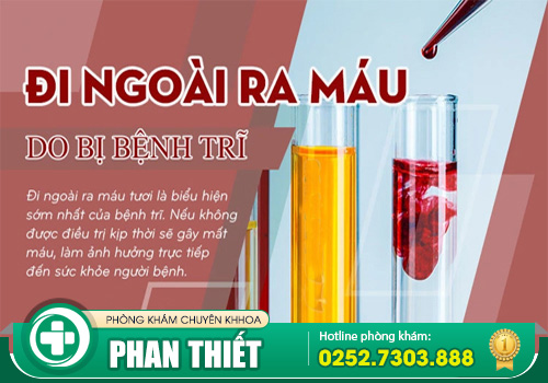 Đi ngoài ra máu - Dấu hiệu điển hình khi bị trĩ