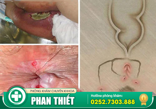 Điều trị bệnh mạch lươn ở đâu đạt hiệu quả cao?