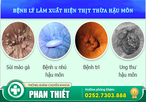 Điều trị thịt dư ở hậu môn bằng cách nào?