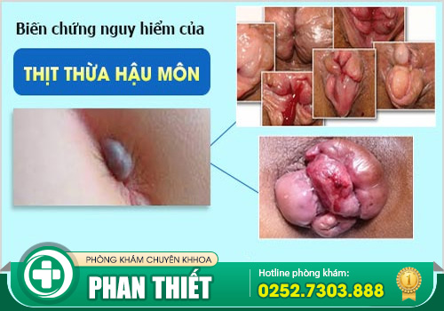 Địa chỉ khám chữa thịt thừa uy tín, có bác sĩ chuyên khoa giỏi