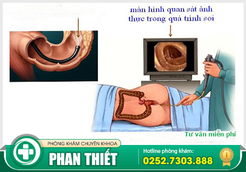 Kiểm tra hậu môn - Phát hiện sớm các bệnh liên quan tới trực tràng hậu môn