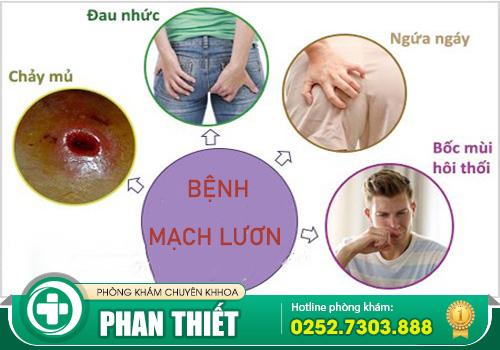 Nguyên nhân bệnh mạch lươn - Triệu chứng và phương pháp hỗ trợ điều trị