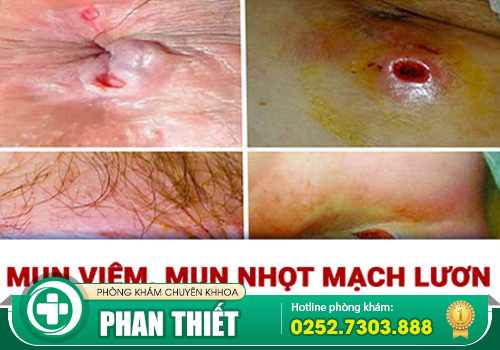 Nhọt mạch lươn - Nguyên nhân, tác hại và cách điều trị