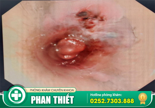 Nội soi hậu môn - Phương pháp chẩn đoán trĩ vô cùng quan trọng