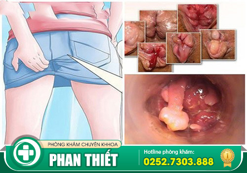 Nội soi trĩ thực hiện như thế nào? Cần lưu tâm gì?