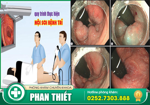 Nội soi trĩ thực hiện như thế nào? Cần lưu tâm gì?