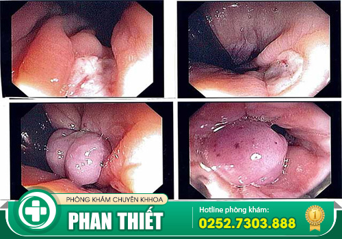 Nội soi trĩ không đau được thực hiện như thế nào?