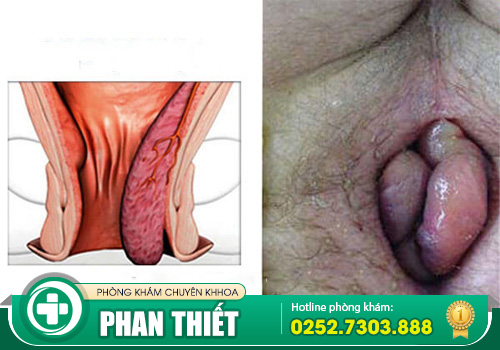 Nội soi trĩ thực hiện như thế nào? Cần lưu tâm gì?