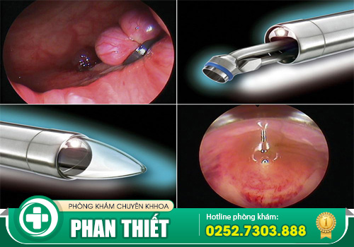 Nội soi trực tràng có đau không? Khi nào cần thực hiện?