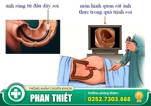 Nội soi trực tràng có đau không? Khi nào cần thực hiện?