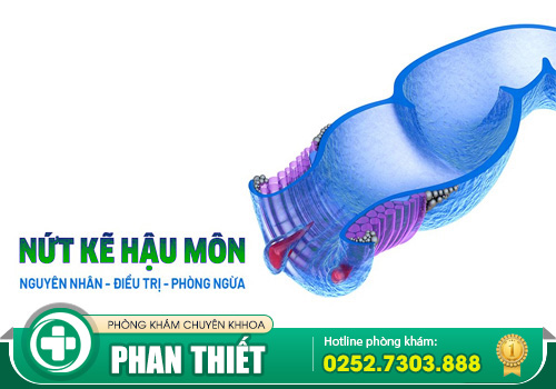 Nứt kẽ hậu môn không phát hiện và điều trị sớm có thể gây biến chứng nguy hiểm