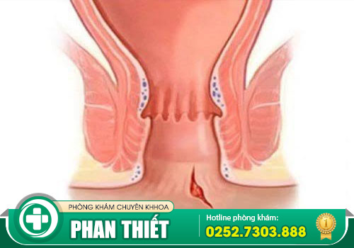Tổng quan về nứt kẽ hậu môn - Nguyên nhân, triệu chứng cùng giải pháp khắc phục