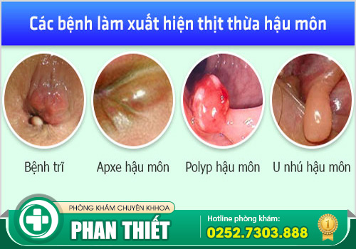 Thịt thừa lỗ hậu môn có nguy hiểm không?