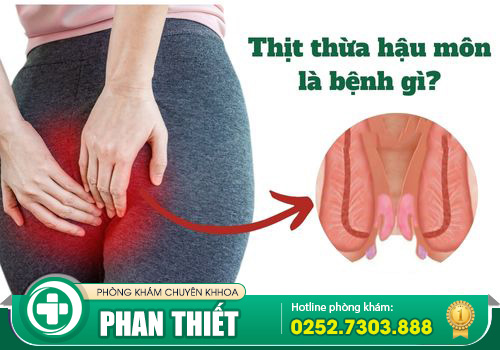 thịt thừa hậu môn