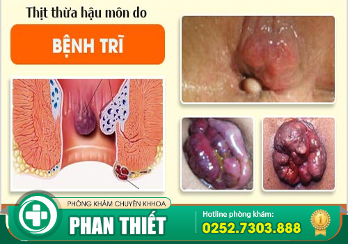 Có cục thịt dư hậu môn có phải bệnh trĩ không?