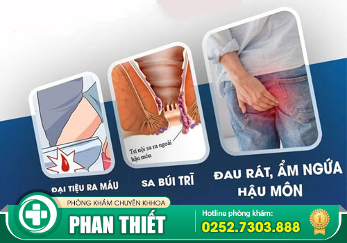 Những triệu chứng bệnh hậu môn trực tràng bạn cần cảnh giác